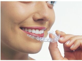 invisalign up close