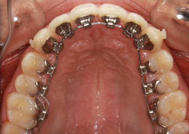 InBrace Lingual Braces - Cooper Orthodontics - Houston & Lake Jackson TX