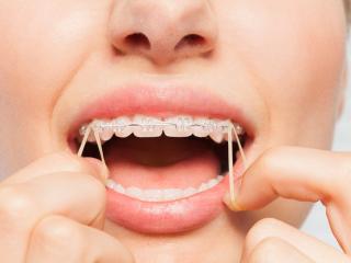 Elastics for Braces - Everything You Need to Know